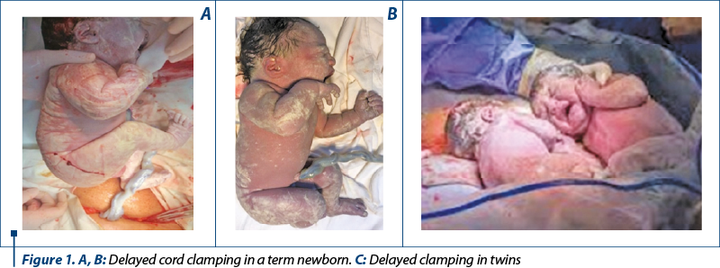 Figure 1. A, B: Delayed cord clamping in a term newborn. C: Delayed clamping in twins