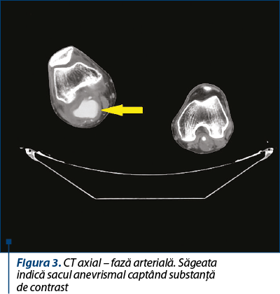 Figura 3. CT axial – fază arterială. Săgeata  indică sacul anevrismal captând substanţă  de contrast