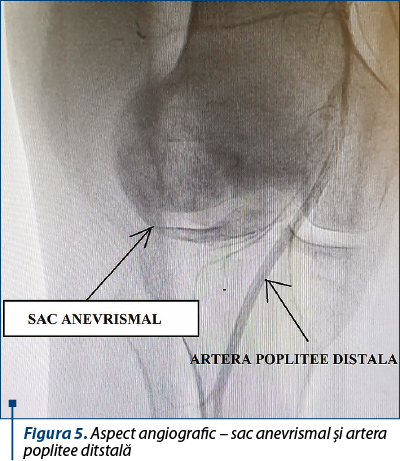 Figura 5. Aspect angiografic – sac anevrismal şi artera poplitee ditstală