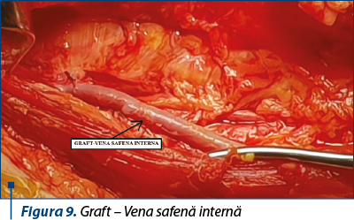 Figura 9. Graft – Vena safenă internă