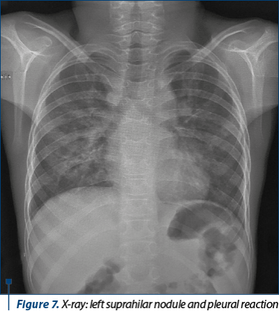Figure 7. X-ray: left suprahilar nodule and pleural reaction