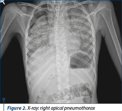 Figure 2. X-ray: right apical pneumothorax