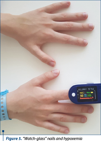 Figure 5. ”Watch-glass” nails and hypoxemia