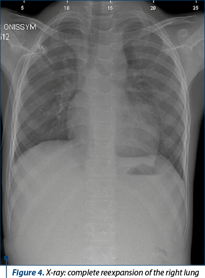 Figure 4. X-ray: complete reexpansion of the right lung
