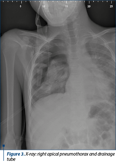 Figure 3. X-ray: right apical pneumothorax and drainage tube