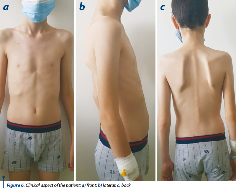 Figure 6. Clinical aspect of the patient: a) front; b) lateral; c) back