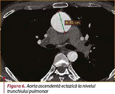 Figura 6. Aorta ascendentă ectazică la nivelul trunchiului pulmonar