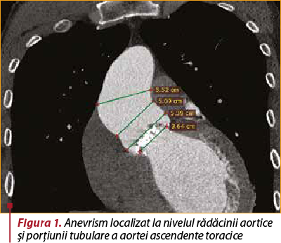 Figura 1. Anevrism localizat la nivelul rădăcinii aortice şi porţiunii tubulare a aortei ascendente toracice