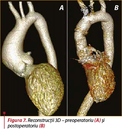 Figura 7. Reconstrucţii 3D – preoperatoriu (A) şi postoperatoriu (B)