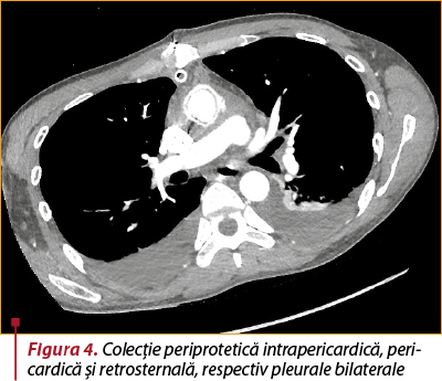 Figura 4. Colecţie periprotetică intrapericardică, peri­car­di­că şi retrosternală, respectiv pleurale bilaterale