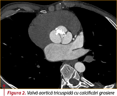 Figura 2. Valvă aortică tricuspidă cu calcificări grosiere