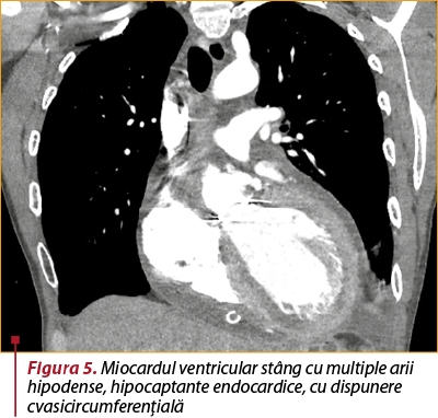 Figura 5. Miocardul ventricular stâng cu multiple arii hipodense, hipocaptante endocardice, cu dispunere cvasicircumferenţială 