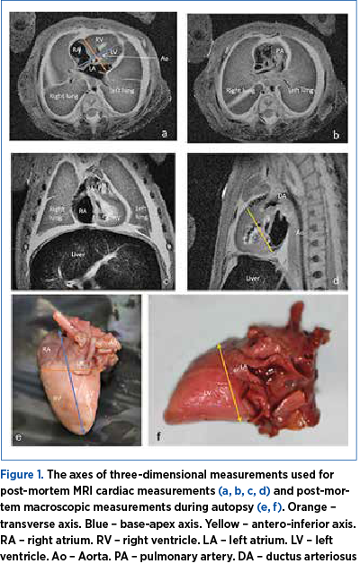 Figure 1. The axes of three-dimensional measurements used for post-mortem MRI cardiac measurements (a, b, c, d) and post-mor­tem macroscopic measurements during autopsy (e, f). Orange – trans­verse axis. Blue – base-apex axis. Yellow – antero-inferior axis. RA – right atrium. RV – right ventricle. LA – left atrium. LV – left ven­tri­cle. Ao – Aorta. PA – pulmonary artery. DA – ductus arteriosus 