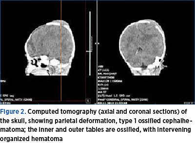 Figure 2. Computed tomography (axial and coronal sections) of the skull, showing parietal deformation, type 1 ossified cephalhematoma; the inner and outer tables are ossified, with intervening organized hematoma 