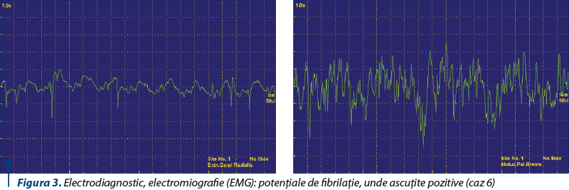 Figura 3. Electrodiagnostic, electromiografie (EMG): potenţiale de fibrilaţie, unde ascuţite pozitive (caz 6) 