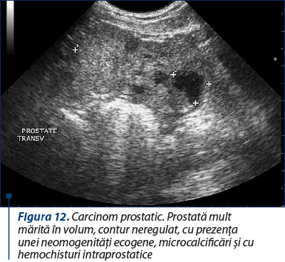Figura 12. Carcinom prostatic. Prostată mult mărită în volum, contur neregulat, cu prezenţa unei neomogenităţi ecogene, microcalcificări şi cu hemochisturi intraprostatice