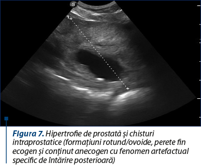 Figura 7. Hipertrofie de prostată şi chisturi intraprostatice (formaţiuni rotund/ovoide, perete fin ecogen şi conţinut anecogen cu fenomen artefactual specific de întărire posterioară)