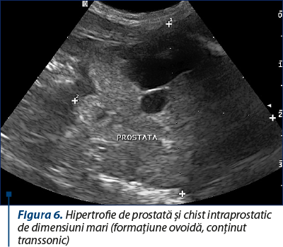 Figura 6. Hipertrofie de prostată şi chist intraprostatic de dimensiuni mari (formaţiune ovoidă, conţinut transsonic)