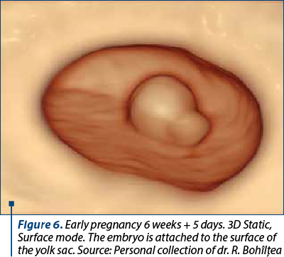 Figure 6. Early pregnancy 6 weeks + 5 days. 3D Static, Surface mode. The embryo is attached to the surface of the yolk sac. Source: Personal collection of dr. R. Bohîlţea