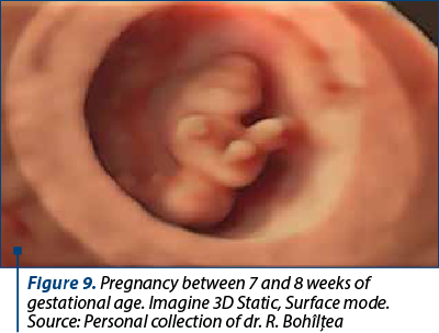 Figure 9. Pregnancy between 7 and 8 weeks of gestational age. Imagine 3D Static, Surface mode. Source: Personal collection of dr. R. Bohîlţea 