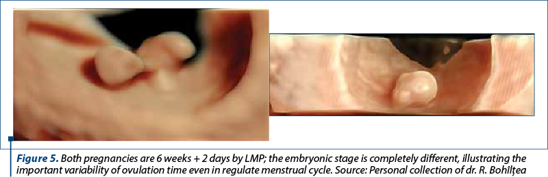 Figure 5. Both pregnancies are 6 weeks + 2 days by LMP; the embryonic stage is completely different, illustrating the important variability of ovulation time even in regulate menstrual cycle. Source: Personal collection of dr. R. Bohîlţea 