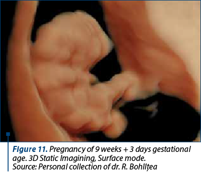 Figure 11. Pregnancy of 9 weeks + 3 days gestational age. 3D Static Imagining, Surface mode.  Source: Personal collection of dr. R. Bohîlţea