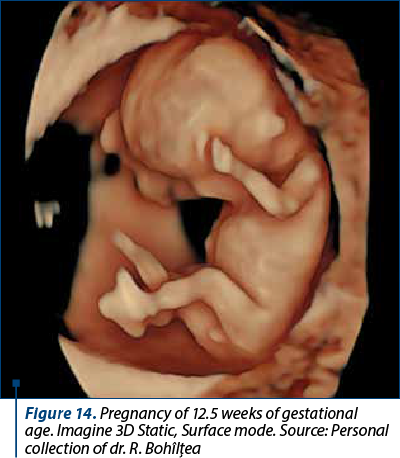 Figure 14. Pregnancy of 12.5 weeks of gestational age. Imagine 3D Static, Surface mode. Source: Personal collection of dr. R. Bohîlţea 