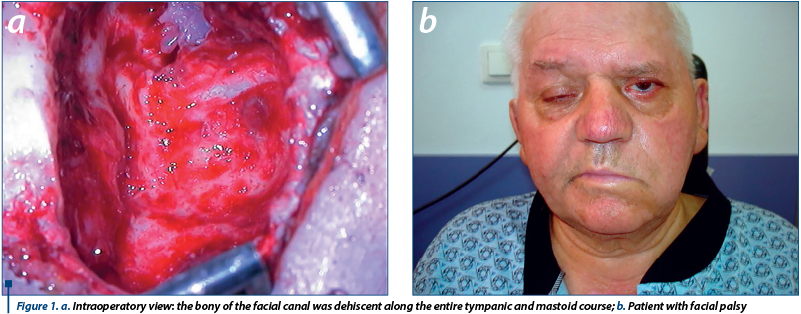 Figure 1. a. Intraoperatory view: the bony of the facial canal was dehiscent along the entire tympanic and mastoid course; b. Patient with facial palsy