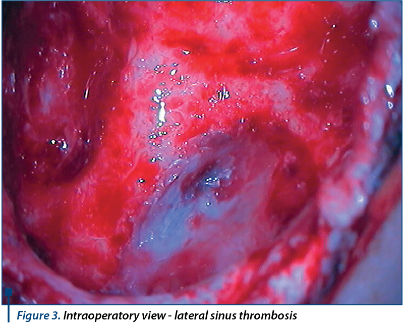 Figure 3. Intraoperatory view - lateral sinus thrombosis