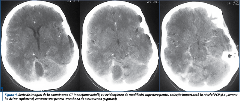 Figura 4. Serie de imagini de la examinarea CT în secţiune axială, cu evidenţierea de modificări sugestive pentru colecţie importantă la nivelul FCP şi a „semnului delta” ispilateral, caracteristic pentru  tromboza de sinus venos (sigmoid)