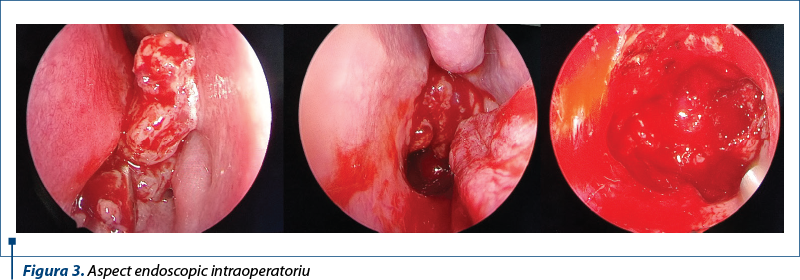 Figura 3. Aspect endoscopic intraoperatoriu
