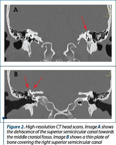 Figure 2. High-resolution CT head scans. Image A shows the dehiscence of the superior semicircular canal towards the middle cranial fossa. Image B shows a thin plate of bone covering the right superior semicircular canal