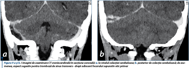 Figura 9 a şi b. I Imagini de examinare CT craniocerebrală în secţiune coronală: a. la nivelul colecţiei cerebeloase; b. posterior de colecţia cerebeloasă; de asemenea, aspect sugestiv pentru tromboză de sinus transvers - drept adiacent focarului supurativ otic primar