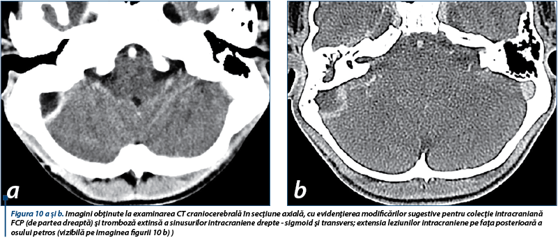 Figura 10 a şi b. Imagini obţinute la examinarea CT craniocerebrală în secţiune axială, cu evidenţierea modificărilor sugestive pentru colecţie intracraniană FCP (de partea dreaptă) şi tromboză extinsă a sinusurilor intracraniene drepte - sigmoid şi transvers; extensia leziunilor intracraniene pe faţa posterioară a osului petros (vizibilă pe imaginea figurii 10 b) )