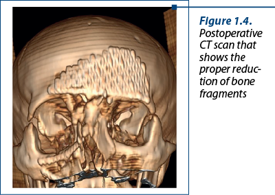 Figure 1.4. Postoperative CT scan that shows the proper re­duc­tion of bone fragments