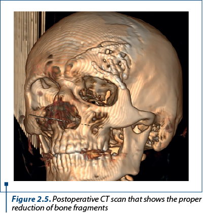 Figure 2.5. Postoperative CT scan that shows the proper reduction of bone fragments