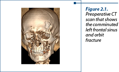 Figure 2.1. Preoperative CT scan that shows the comminuted left frontal sinus  and orbit fracture