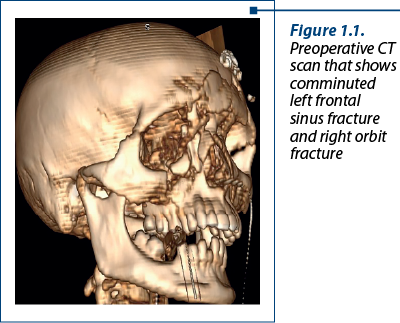 Figure 1.1. Preoperative CT scan that shows comminuted left frontal sinus fracture and right orbit fracture