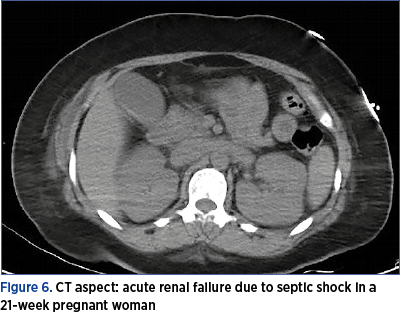 Figure 6. CT aspect: acute renal failure due to septic shock in a 21-week pregnant woman