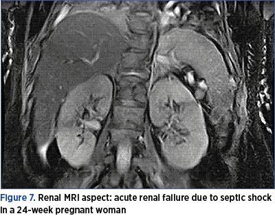 Figure 7. Renal MRI aspect: acute renal failure due to septic shock in a 24-week pregnant woman