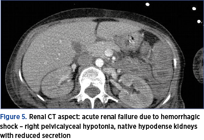 Figure 5. Renal CT aspect: acute renal failure due to hemorrhagic shock – right pelvicalyceal hypotonia, native hypodense kidneys with reduced secretion