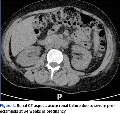 Figure 4. Renal CT aspect: acute renal failure due to severe preeclampsia at 34 weeks of pregnancy