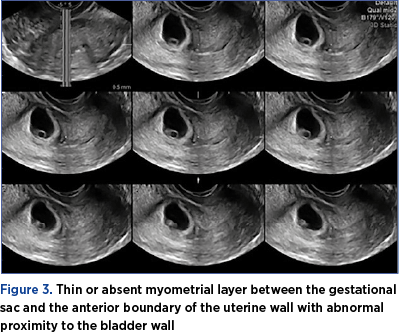 Figure 3. Thin or absent myometrial layer between the gestational sac and the anterior boundary of the uterine wall with abnormal proximity to the bladder wall 