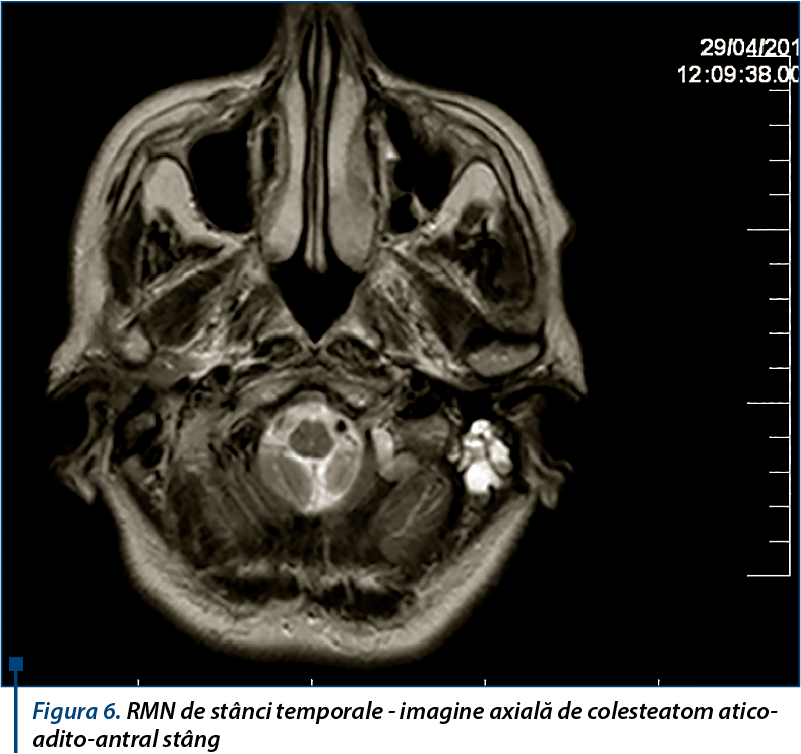 Figura 6. RMN de stânci temporale - imagine axială de colesteatom atico-adito-antral stâng