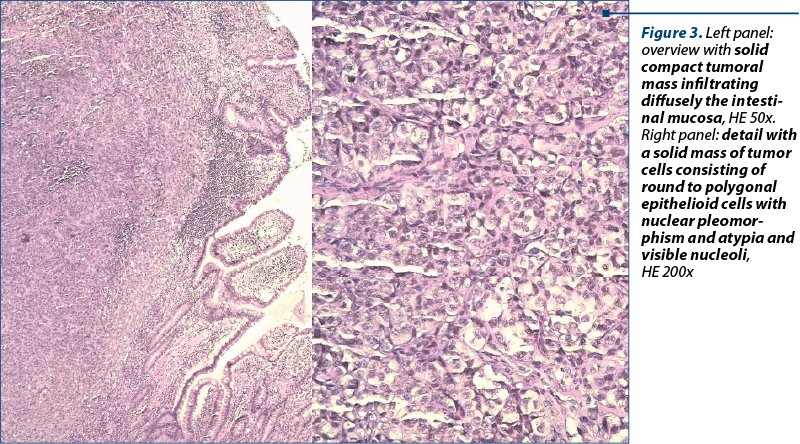 Figure 3. Left panel: over­view with solid com­pact tumoral mass in­fil­tra­ting diffusely the in­tes­ti­nal mucosa, HE 50x.  Right panel: detail with a solid mass of tumor cells consisting of round to polygonal epi­the­lio­id cells with nu­clear pleo­mor­phism and aty­pia and visible nu­cle­oli,  HE 200x