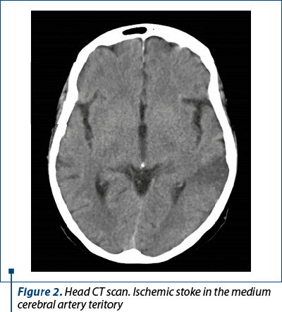 Figure 2. Head CT scan. Ischemic stoke in the medium cerebral artery teritory 