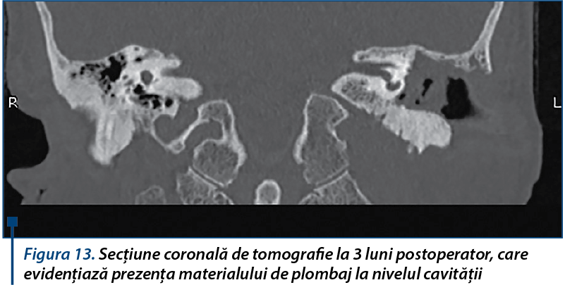 Figura 13. Secţiune coronală de tomografie la 3 luni postoperator, care evidenţiază prezenţa materialului de plombaj la nivelul cavităţii