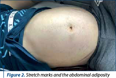 Figure 2. Stretch marks and the abdominal adiposity