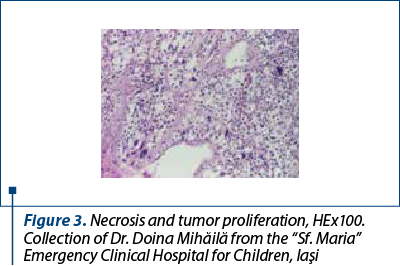 Figure 3. Necrosis and tumor proliferation, HEx100. Collection of Dr. Doina Mihăilă from the “Sf. Maria” Emergency Clinical Hospital for Children, Iaşi