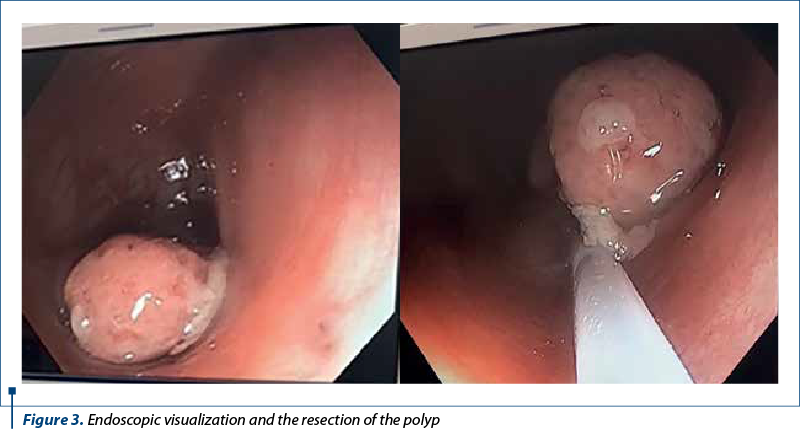 Figure 3. Endoscopic visualization and the resection of the polyp